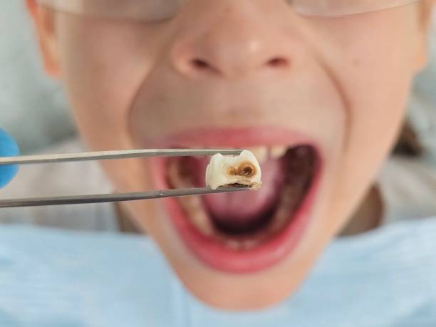 Best Pediatric Emergency Dentist in Vaville, CA